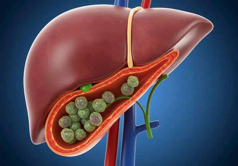 How To Reduce Gall Bladder Stones?